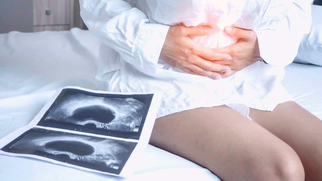 Un estudio vincula el cáncer de ovario con la colonización bacteriana en el microbioma
